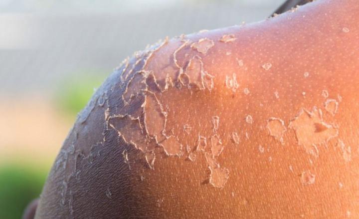 墨尔本21岁女子皮肤严重烧伤,被紧急抢救,医疗部门已发出警告