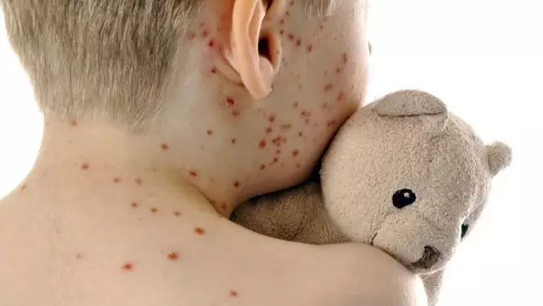 世卫组织急了:意大利急需控制麻疹疫情! - 华人头条