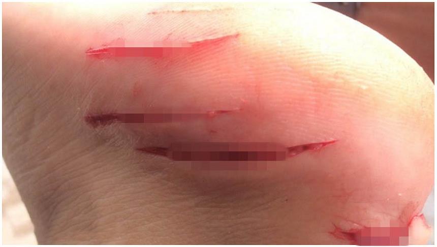 日本游客在泰国被不明海洋生物咬伤缝了50针 官方否认是鲨鱼