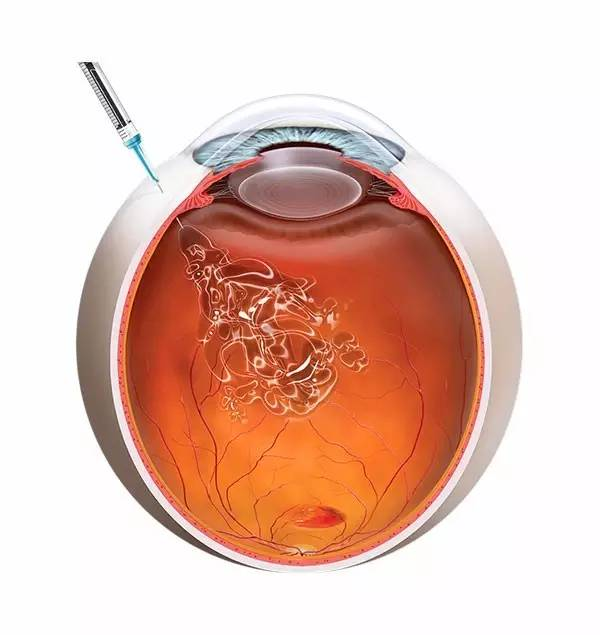 瑞士苏黎世联邦理工大学:用机器人攻克黄斑变性眼内注射治疗手术难题