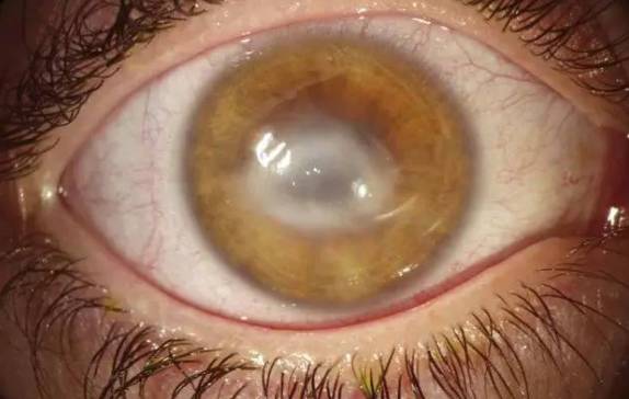 澳洲妈妈眼睛长虫,头发掉光,身体瘫痪,被药物和手术折磨整整十年