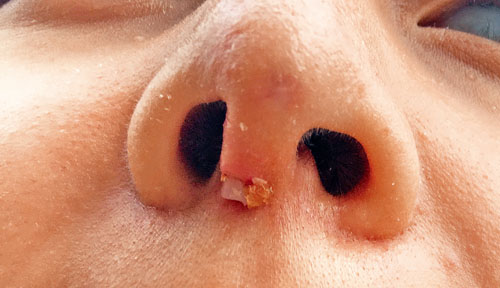 李女士鼻子的红肿状况并没有得到好转,而隆入鼻子的假体竟然在上周撑