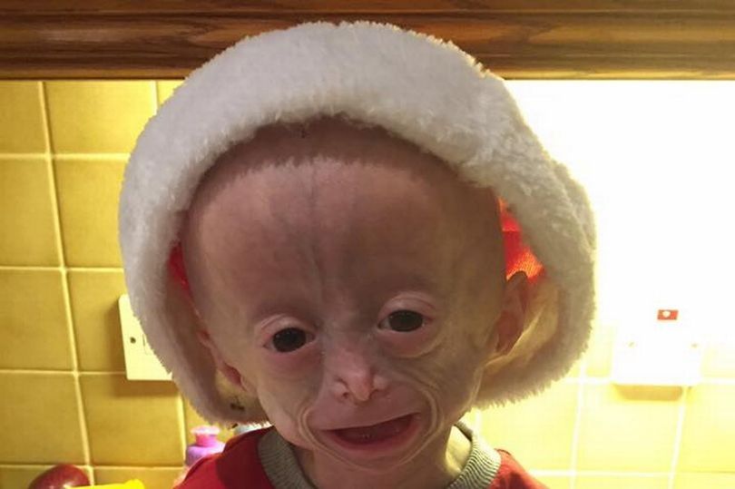 英国早老症女孩去世,8岁看上去像60多岁