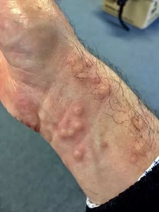 阿德jimble水母数量激增抢热度今年已有14人被蛰伤不致命但疼死你