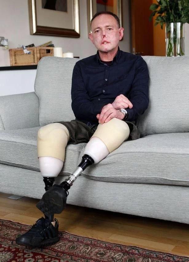 只因被宠物狗舔了下,英男子失去了四肢和鼻子,只有20%机会可活