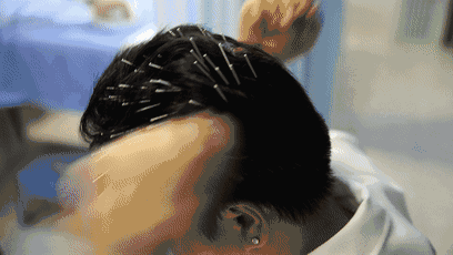 中医师在自己头上扎了146根针,目的就是为了消除老外对中医针灸的恐惧