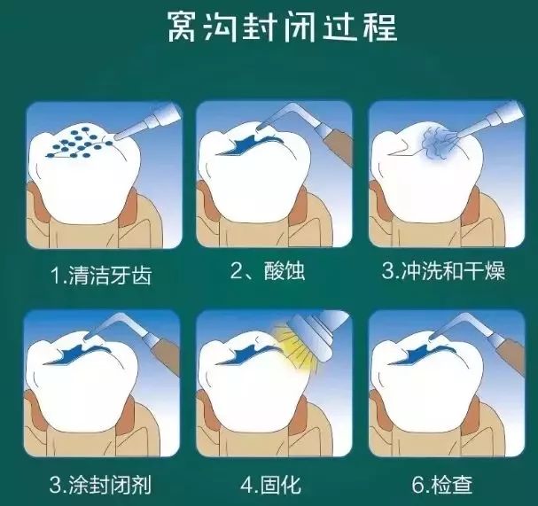 你家娃做窝沟封闭防蛀牙全免费!千万别错过!