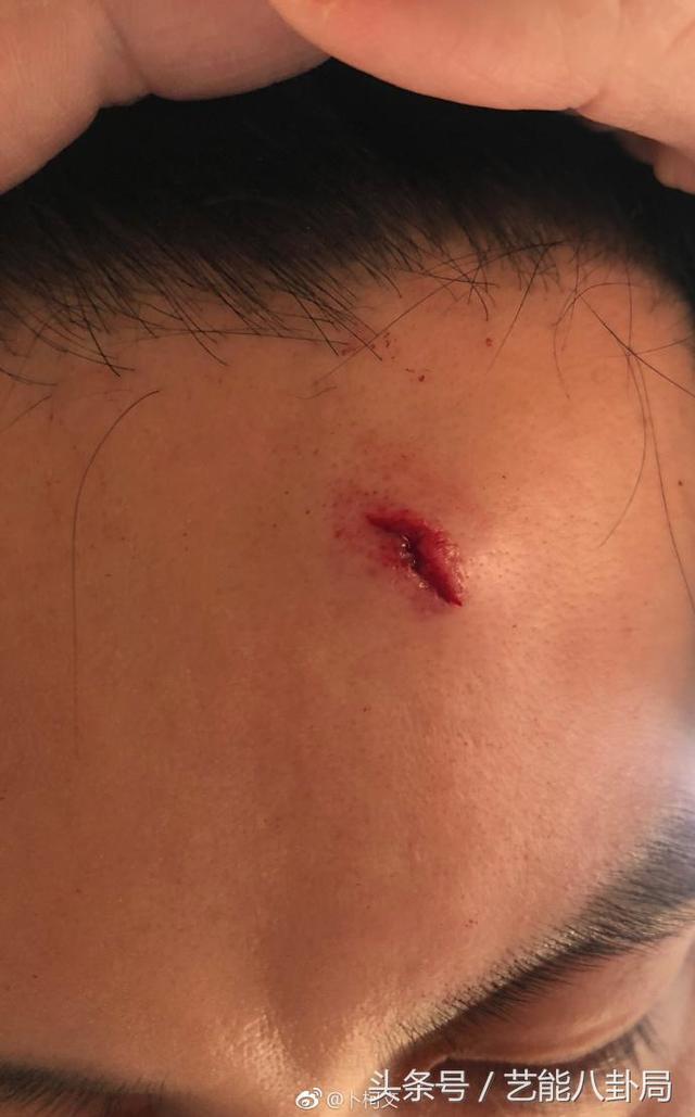 节目组在山西太原晋商博物馆录制过程中,李晨被学士帽划伤,额头出血