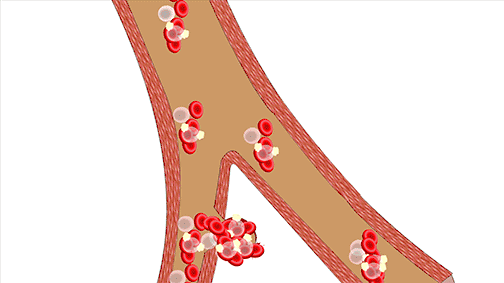 二,缺血性脑卒中