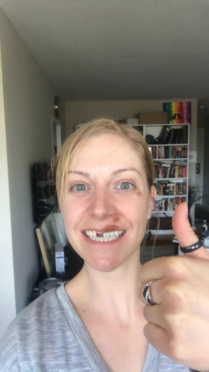 喝多了几杯酒,这个妹子直接断片摔断了门牙,可以说是倒霉透了