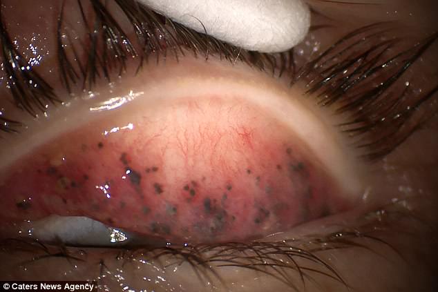 吓人!25年未好好卸睫毛膏 浓妆女子眼睑内长满斑点