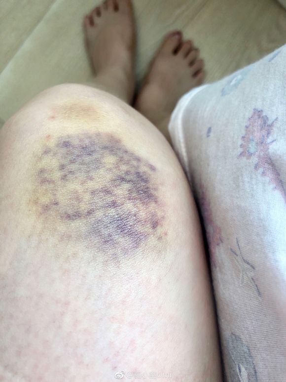 doinb女友被车撞伤,韩国警察包庇嫌犯,网友:棒子就这样