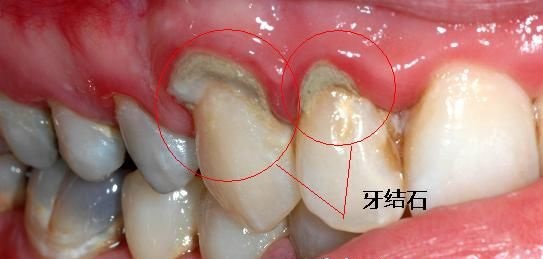 牙周疾病症状包括:发现牙周袋变深(深度大于5毫米),x光检查可见牙槽骨