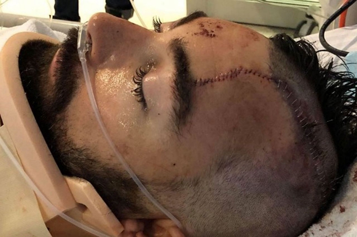 澳洲父舍身救8岁儿 充当人肉垫露台堕下摔裂头骨